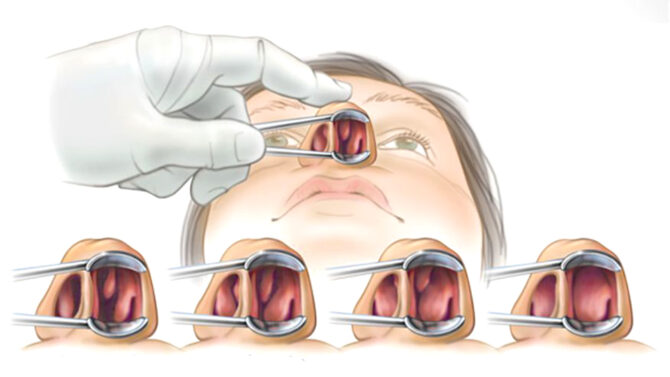 Turbinate Hypertrophy