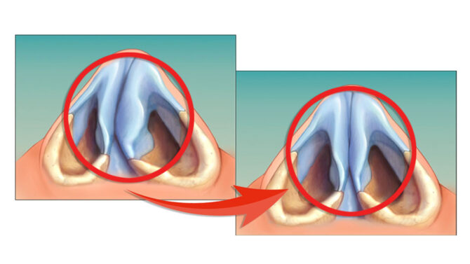 eythiasi_rinikou_diafragmatos