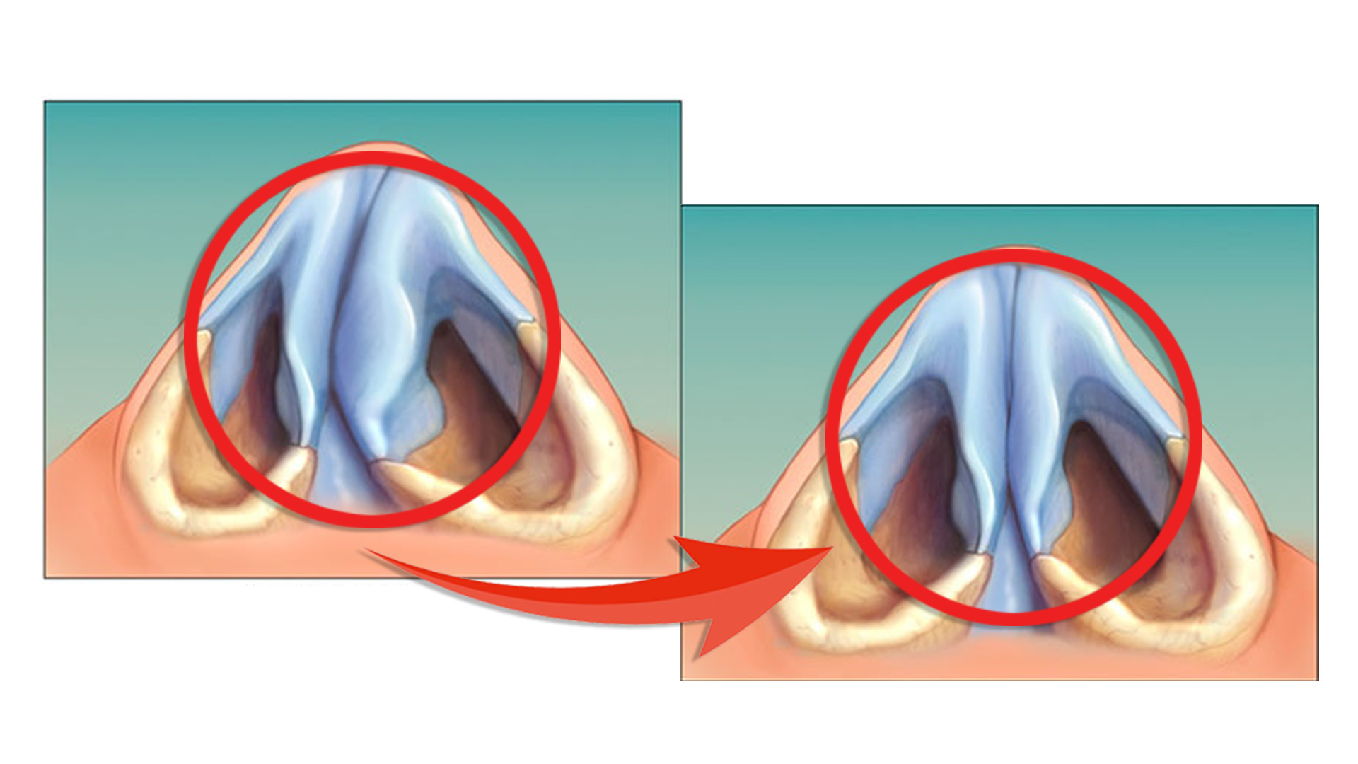 eythiasi_rinikou_diafragmatos