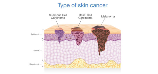 Αφαίρεση δερματικών καρκίνων_hero_image