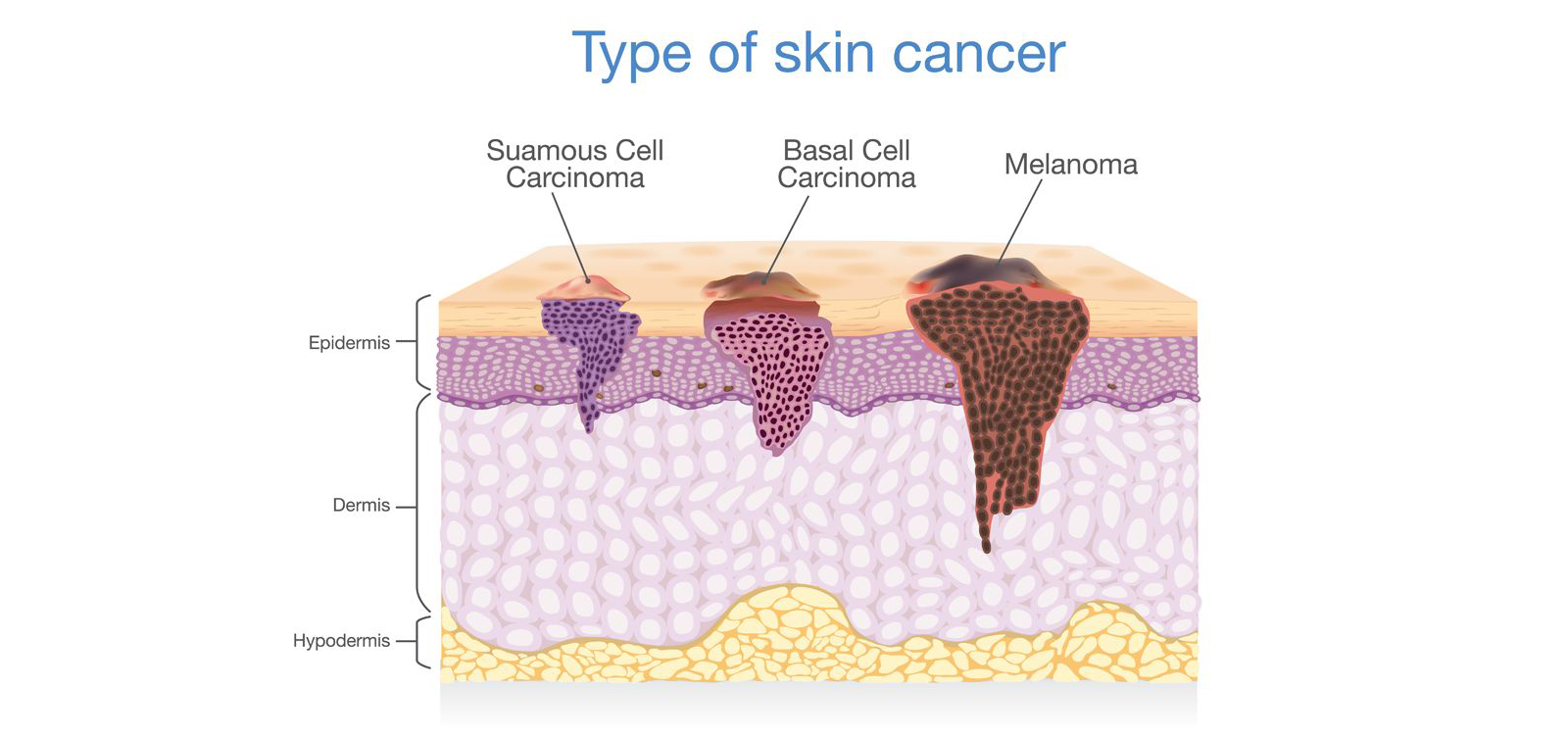 Αφαίρεση δερματικών καρκίνων_hero_image
