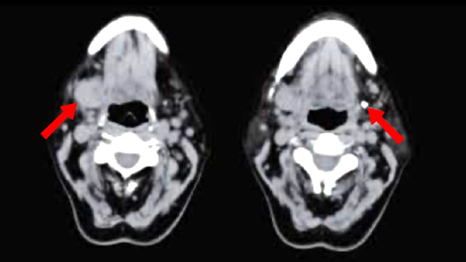 Αφαίρεση υπογναθίου