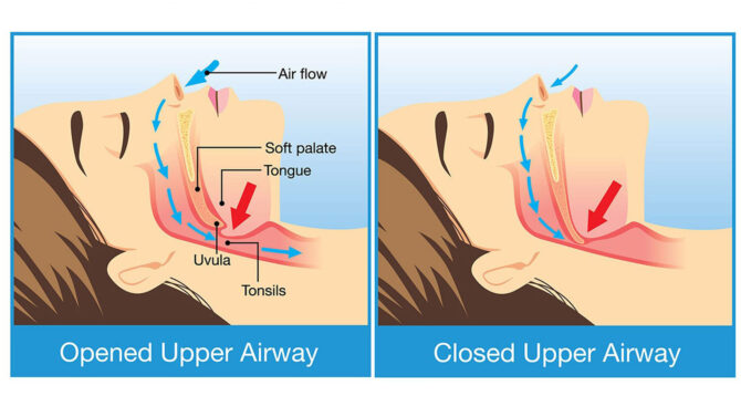 Ροχαλητό και υπνική άπνοια