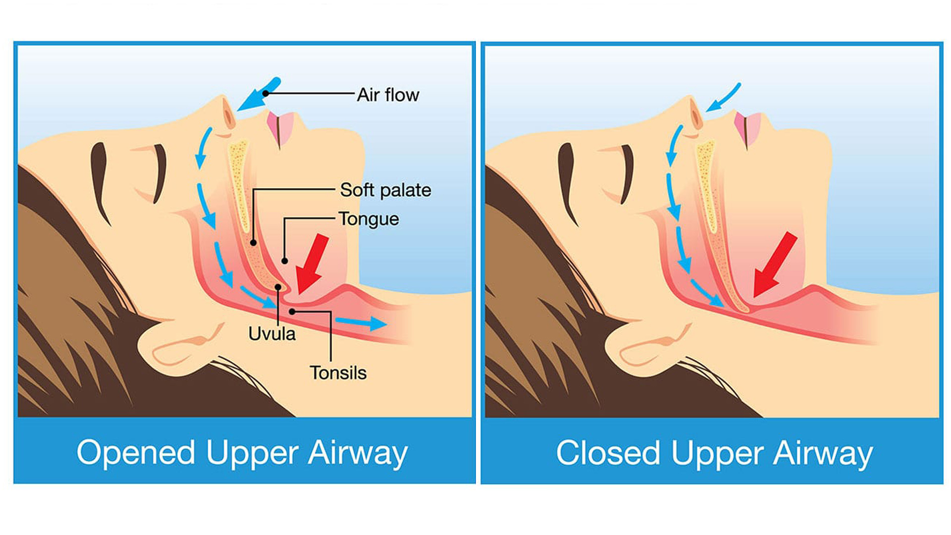 Ροχαλητό και υπνική άπνοια