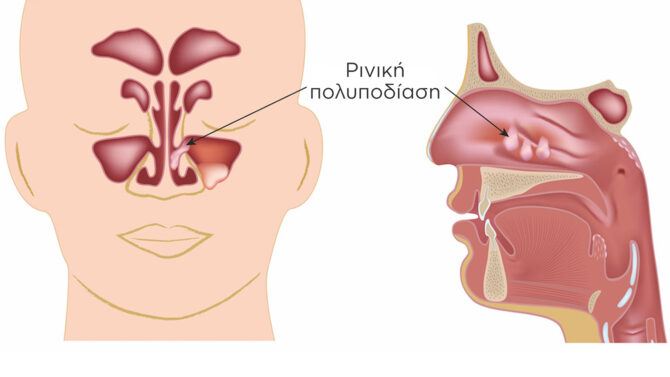 ρινική πολυποδίαση image