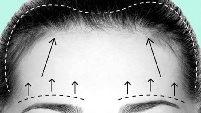 Buccal Fat Reduction