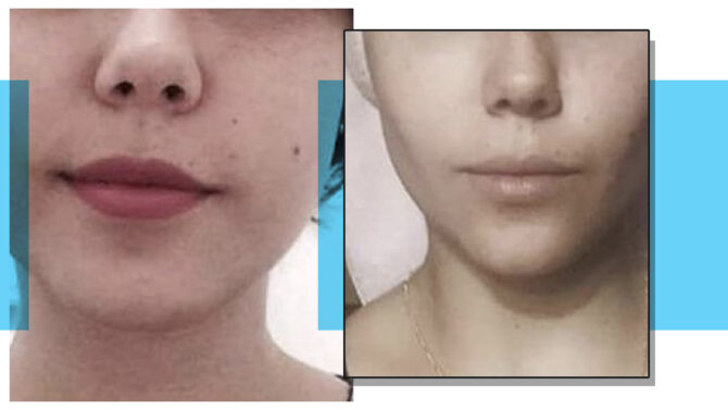 Buccal Fat Reduction hero image