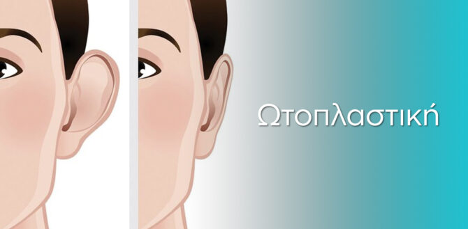 Otoplasty_hero