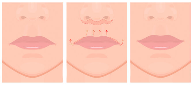 liplift_hero_image