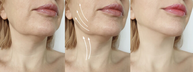 midface_Lift_hero_image