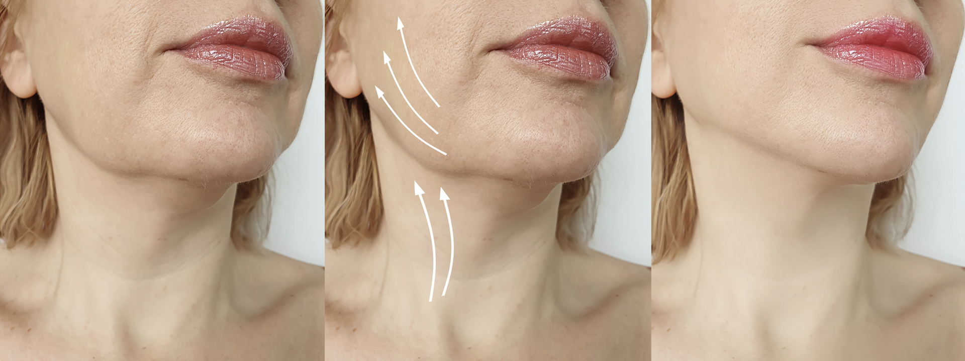 midface_Lift_hero_image