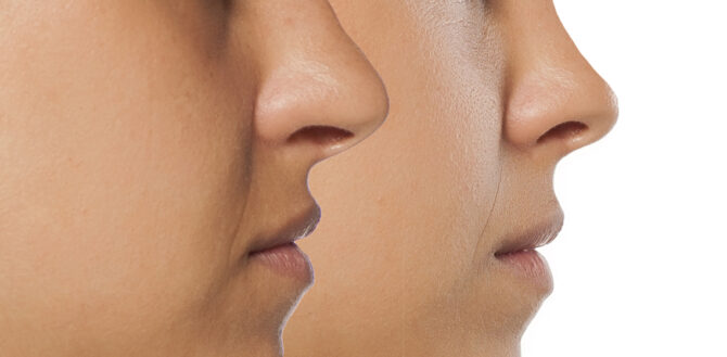 Αναίμακτη Ρινοπλαστική _hero_image