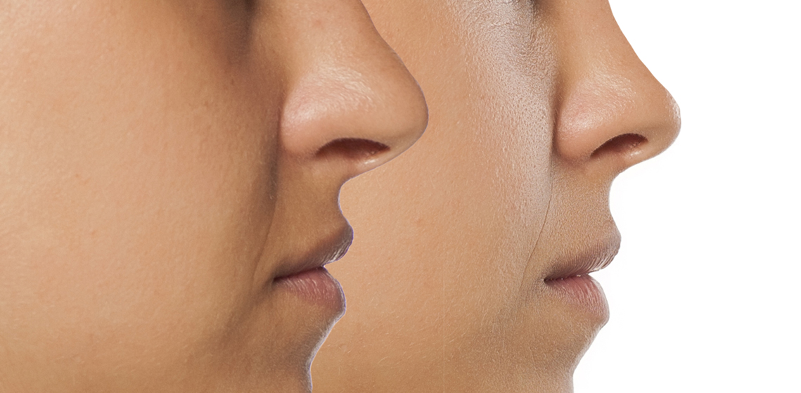 Αναίμακτη Ρινοπλαστική _hero_image