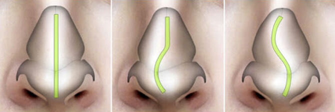 Λειτουργική ρινοπλαστική_hero_image