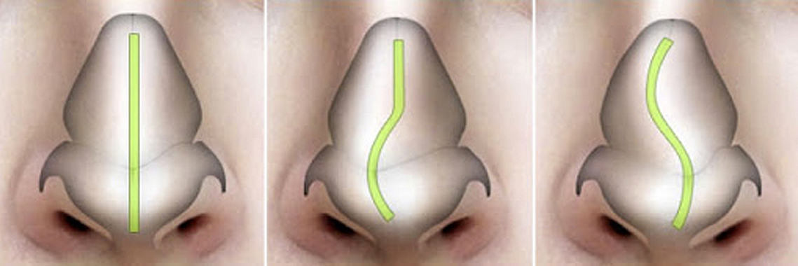 Λειτουργική ρινοπλαστική_hero_image