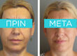 facelift-example - before and after - Dr. Sofia D. Parlavantza