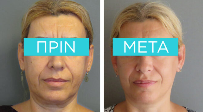 facelift-example – before and after – Dr. Sofia D. Parlavantza facelift-example - before and after - Dr. Sofia D. Parlavantza