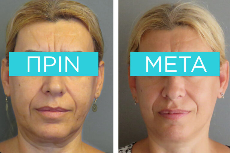 facelift-example - before and after - Dr. Sofia D. Parlavantza