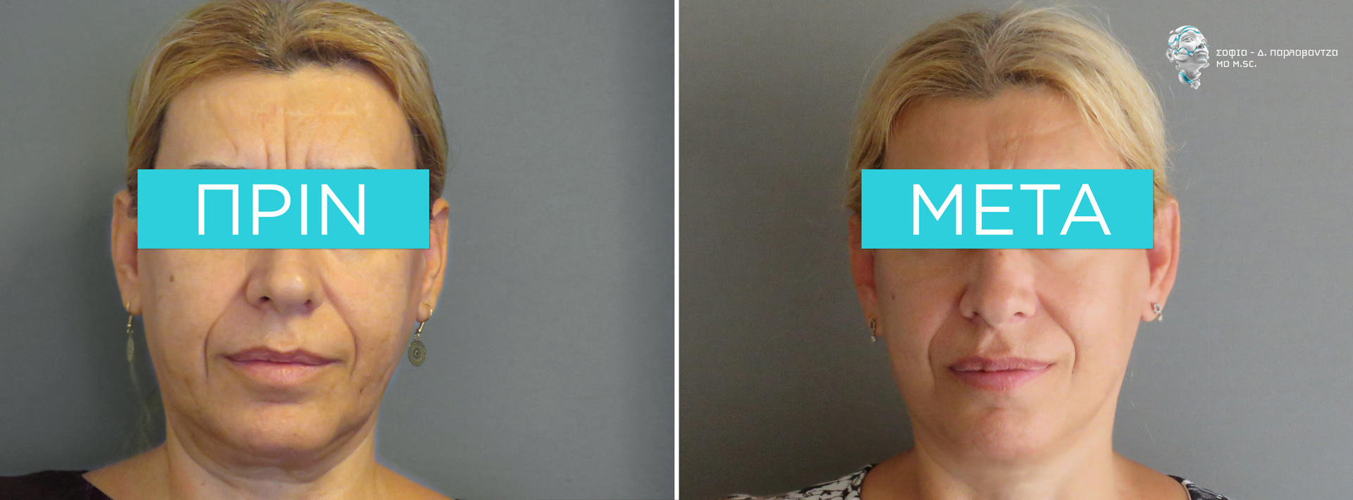 Example of before and after facelift - Dr. Sofia D. Parlavantza